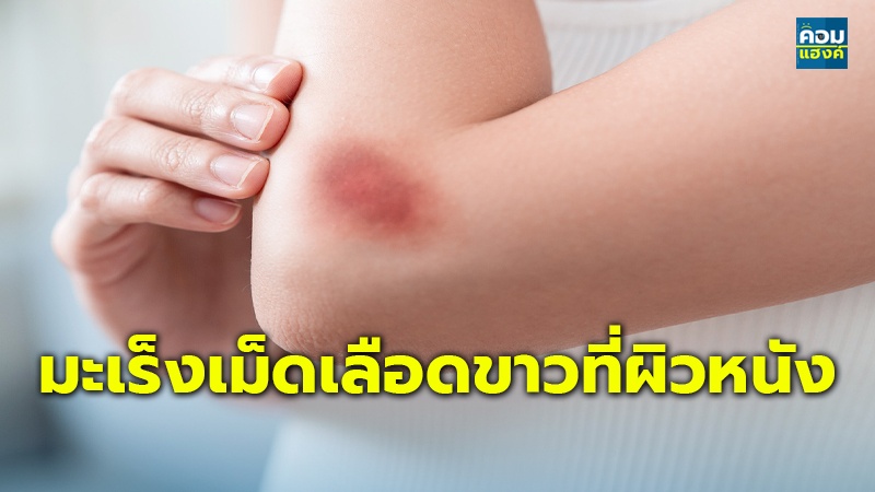 มะเร็งเม็ดเลือดขาวที่ผิวหนัง.jpg